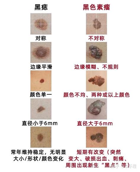 大黑痣|这样的黑痣竟是“黑色素瘤”！医生：超过这个尺寸的黑。